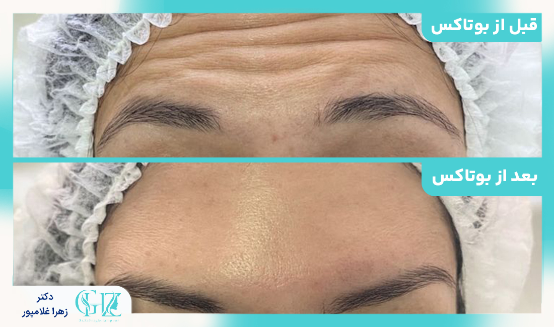 مزایا و فواید تزریق بوتاکس در بهترین کلینیک زیبایی در فسا