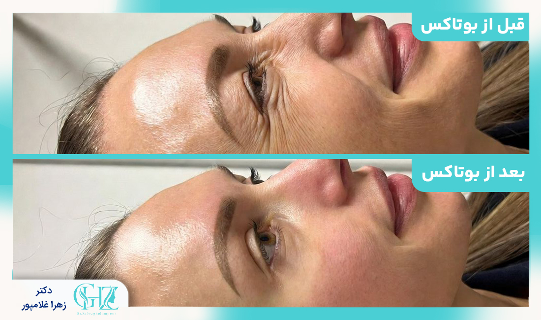 مزایا و فواید تزریق بوتاکس