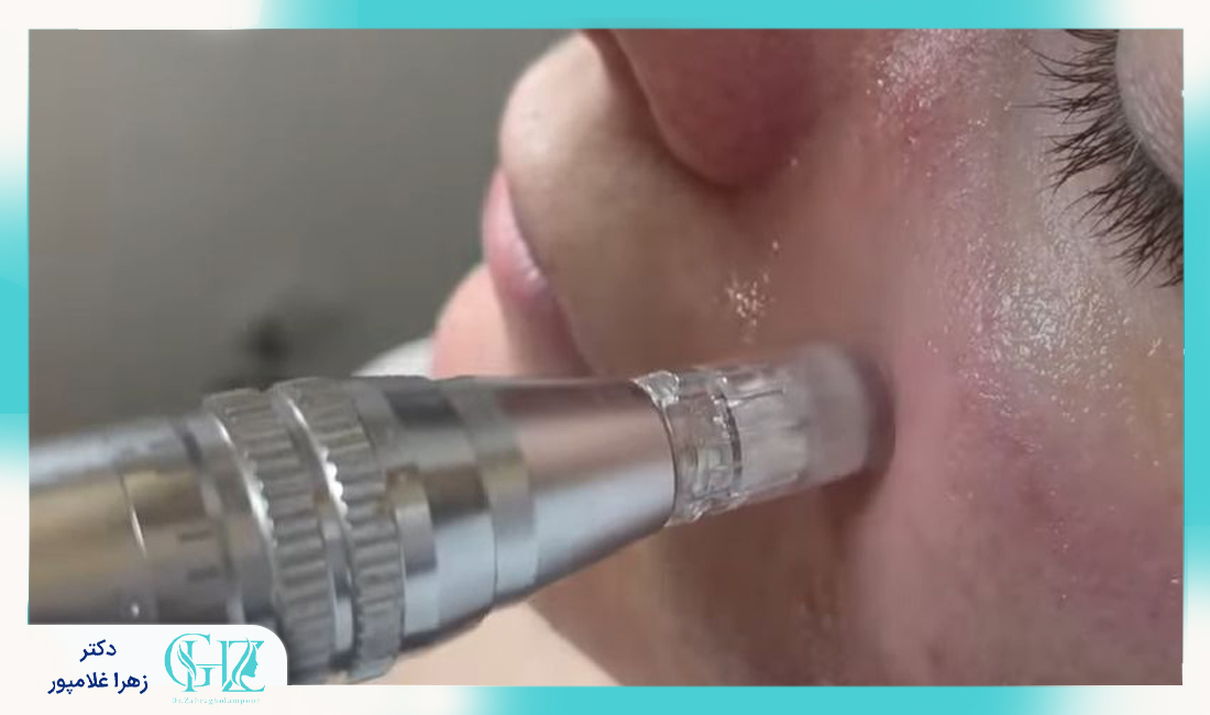 موارد کاربرد و مزایای مزوتراپی