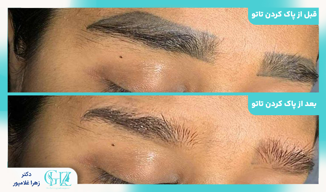 مقایسه روش های مختلف پاک کردن تاتو