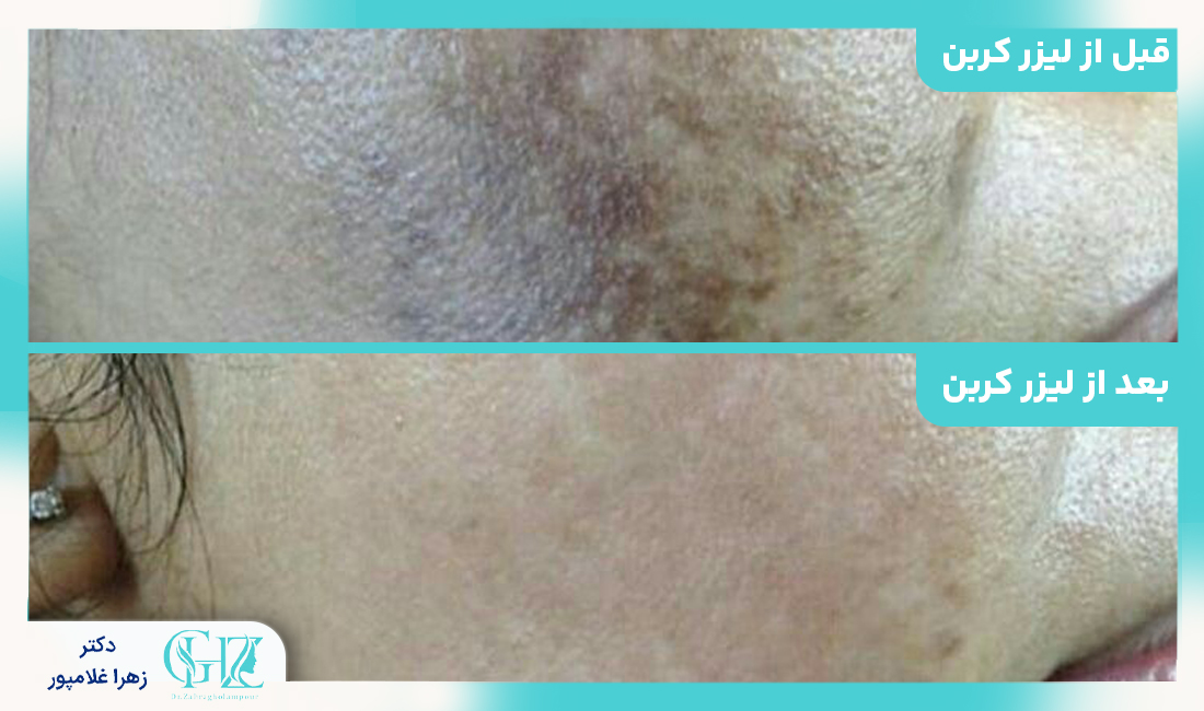 مقایسه با سایر روش های جوانسازی پوست