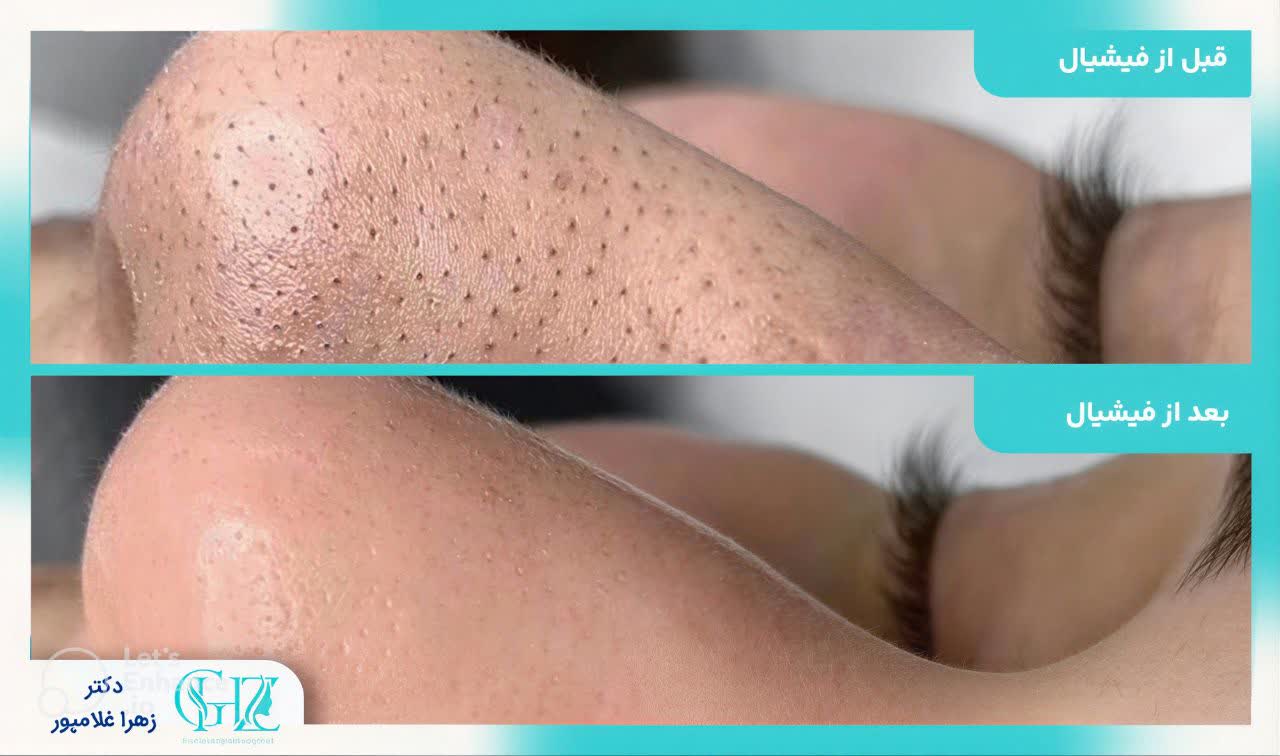 تاریخچه فیشیال پوست