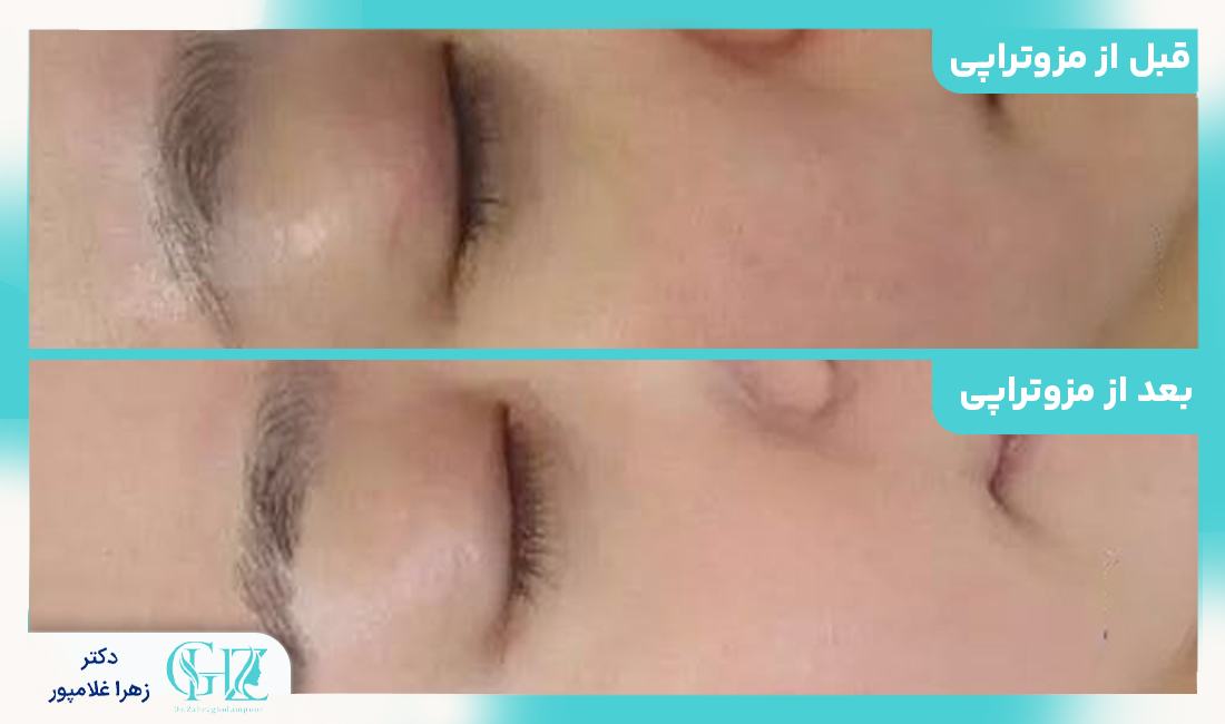 نکات مهم در انتخاب مرکز مزوتراپی در فسا