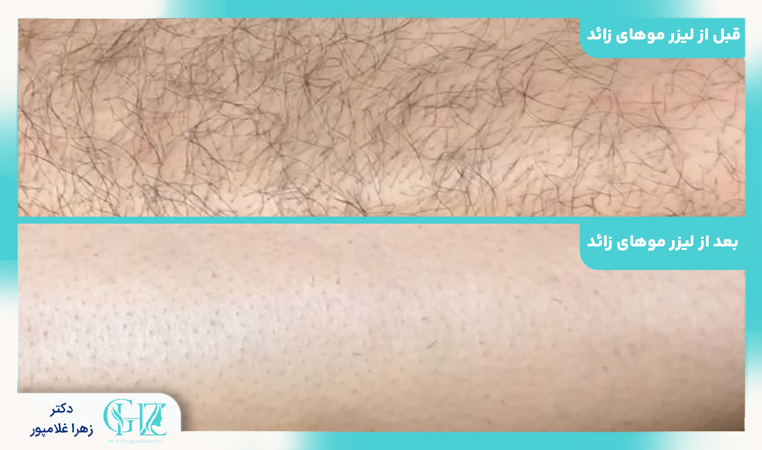 عوارض و خطرات احتمالی لیزر