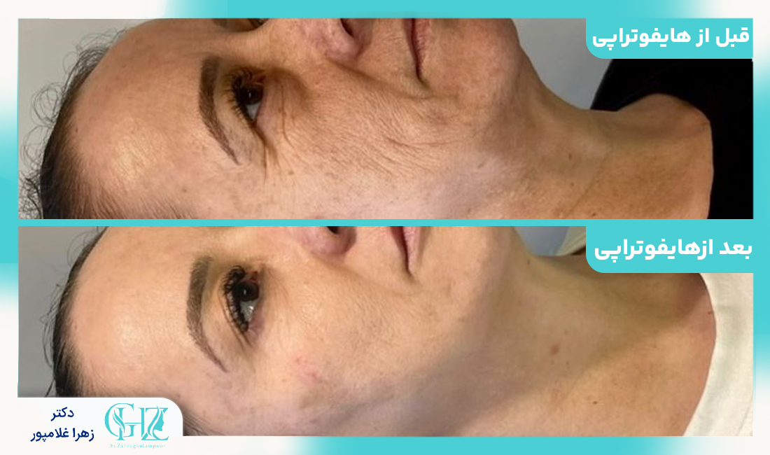 هایفوتراپی چیست و چگونه انجام میشود؟