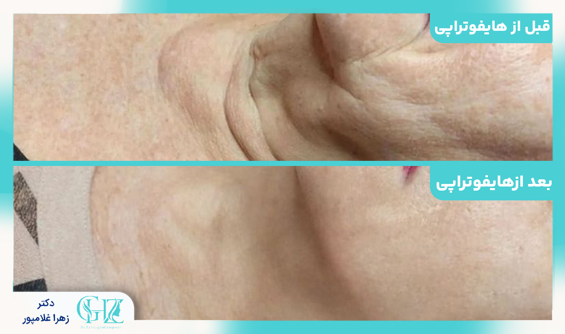 عوارض و مراقبتهای هایفوتراپی
