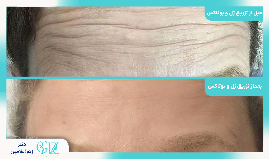تفاوت بوتاکس و ژل
