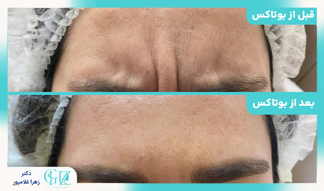 بوتاکس چیست و چگونه عمل می‌کند؟
