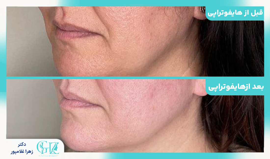 هایفوتراپی چیست و چگونه کار میکند؟