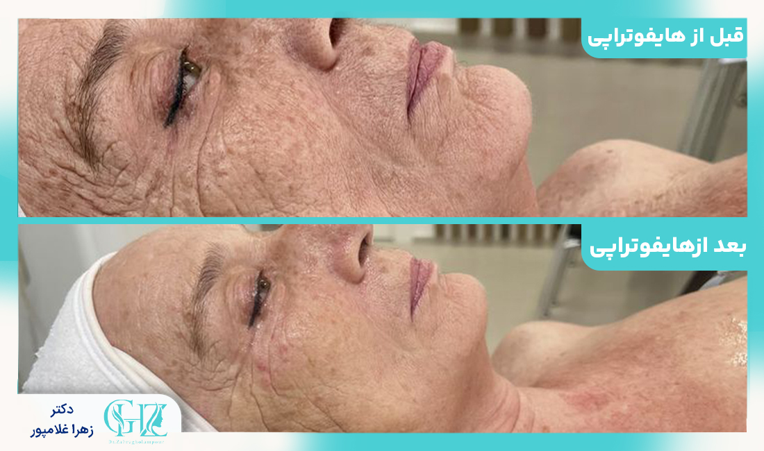 عوارض احتمالی و موارد منع مصرف