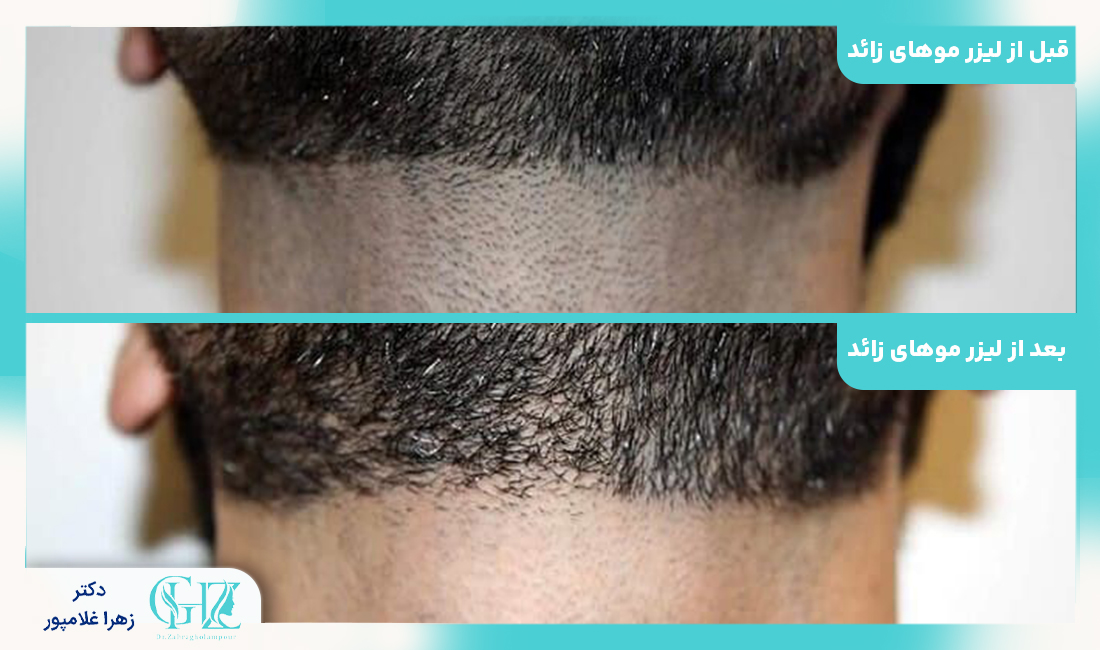 لیزر موهای زائد چیست و چگونه کار می‌کند؟