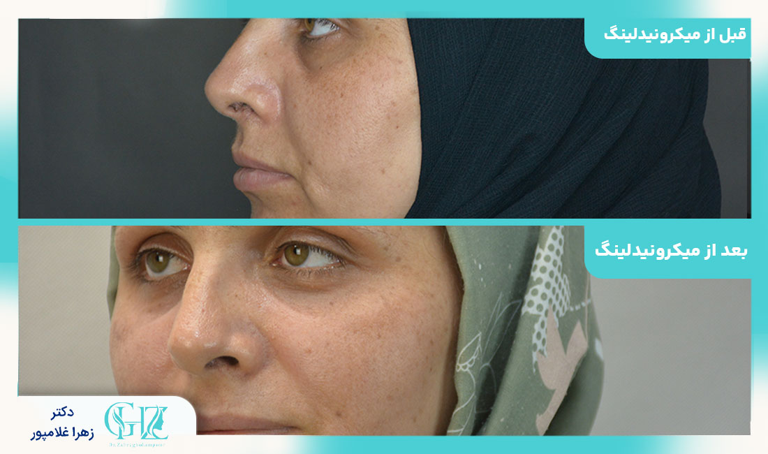 هزینه و تعداد جلسات میکرونیدلینگ در فسا